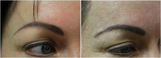 closeup eyebrow transplant results nape hair
