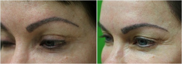 excellent eyebrow transplant results on patient