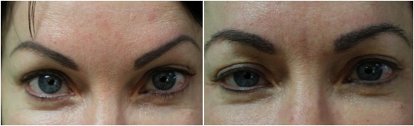 Eyebrow Transplant Using uGraft in Los Angeles results covers brow tattoos