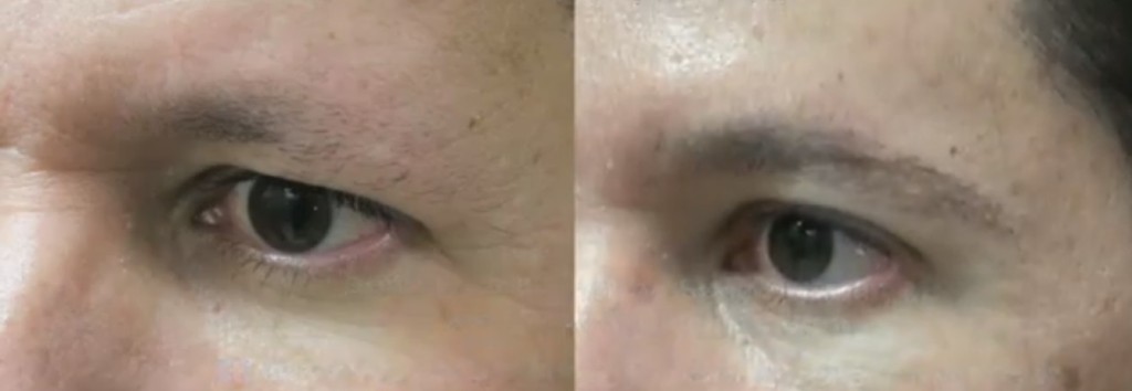 Eyebrow transplant results -improved definition