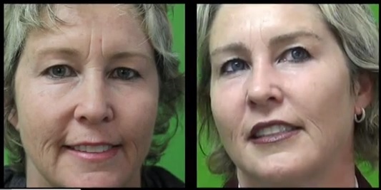 Eyebrow Restoration by Dr. U Before and After