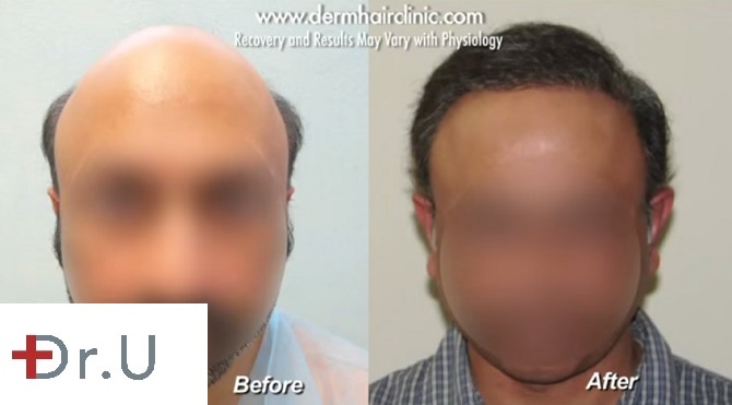 Severe Baldness solved by UGraft Advanced Follicular Unit Extraction