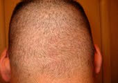 The following picture shows a scalp donor area as it appears at only 6 days after Dr. Umar removed 2300 grafts by FUE