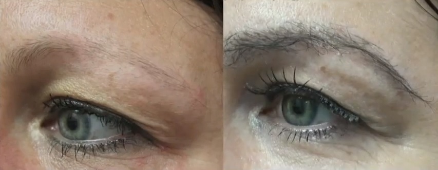 Eyebrow Transplant Results|Nape Hair Grafts - Before & After