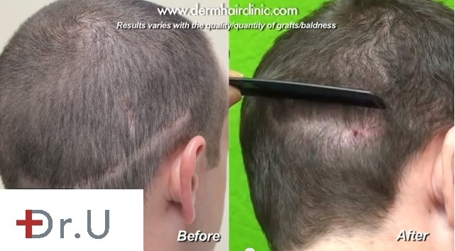 Large Strip Scar| Repair With Head Donor Hair and FUE