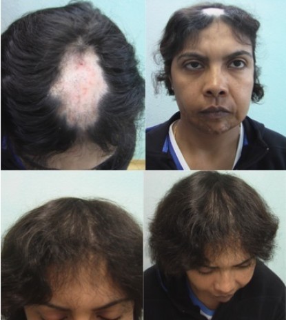 Women and hair transplant results of a woman suffering hair loss from lupus.
