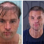 How does UGraft BHT differ from traditional hair transplants ?