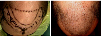  	The following patient had hair implanted to his frontal scalp 1 week before.