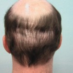 Figure 1: Large round scars from the Orentreich style punch extractions performed at another clinic. The patient presented to Dr. Umar to have these repaired.