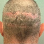 Figure 3: A strip scar from the traditional strip method of hair transplantation.