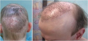 Figure 5a: Patient with no head donor hair left after previously botched surgeries at another clinic, before an “Umar Procedure.”