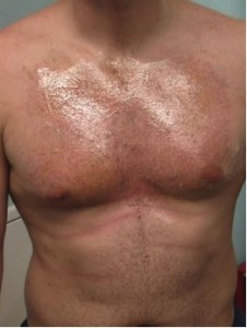 Figure 5b: Example of a chest hair harvest soon after an “Umar Procedure” of FUE.