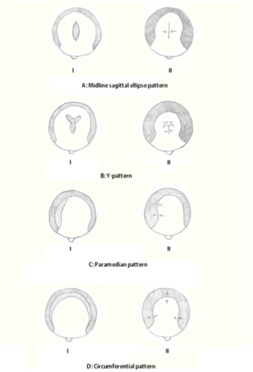 Figure 1: Top-down views of the scalp depicting the four patterns of scalp reduction.