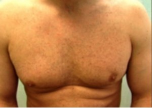 Figure 10a: After extraction of thousands of grafts from the chest.