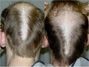 Figure 1a: Examples of a slot deformity in a scalp reduction complication.