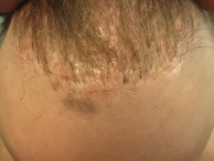 Figure 4: Dolls hair of punch graft method of hair transplant.