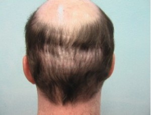 Figure 5: Punch graft donor scars.