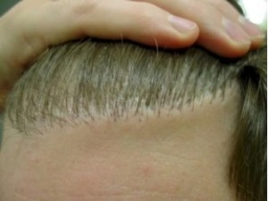 Figure 6: Pluggy hairline from minigraft method of hair transplantation.