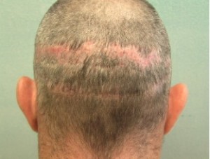 Figure 7: Apparent linear scar from FUSS.