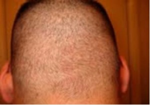 Figure 8: FUE donor healing.
