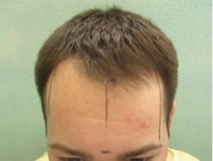 Figure 9a: Dr. Umar patient before 3200 FUE.