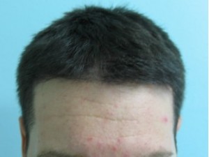 Figure 9b: Dr. Umar patient after 3200 FUE graft.