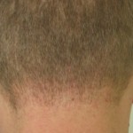 Tiny wounds of UGraft follicular unit extraction in a Los Angeles patient performed by The Umar Procedure, soon after surgery from 2006. Patient at 5 months. Tiny wounds of UGraft follicular unit extraction in a Los Angeles patient performed by The Umar Procedure, soon after surgery from 2006. Patient at 5 months.