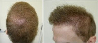 Follicular Unit Extraction