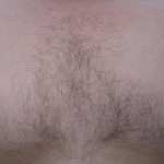For body hair transplantation (BHT), Dr. Umar used hair from the chest. 