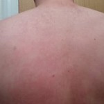 For BHT, Dr. Umar also used hair from the patient's back.