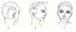 FUE hair restoration 1 Figure 2: A) Shows where the temporoparieto-occipital flap is cut. B) Shows the excised flap. C) Shows the final placement of the flap.