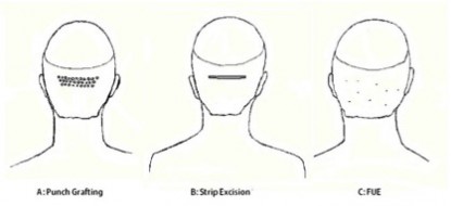 Figure 3: Schematic representations of methods of graft creation/extraction.