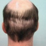 Figure 4: Punch graft donor scars.
