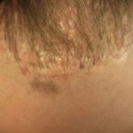 Figure 5: "Dolls hair" from punch graft method of hair transplant.
