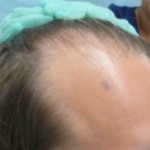 Figure 7a: A patient of Dr. Umar before hairline restoration by FUE.