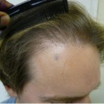 Figure 7b: Same Dr. Umar patient after FUE, which results in a more cosmetically appealing outcome than punch grafting.