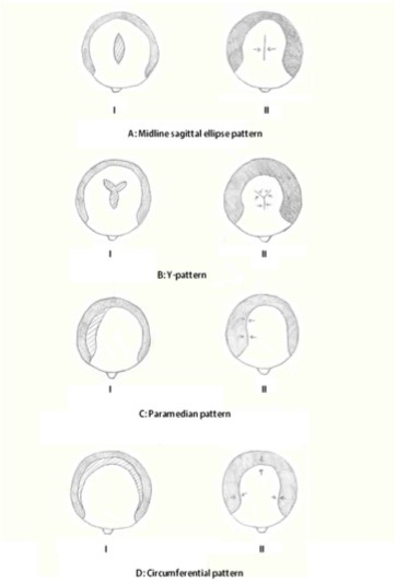 Figure 1: Top-down views of the scalp depicting the four patterns of scalp reduction.
