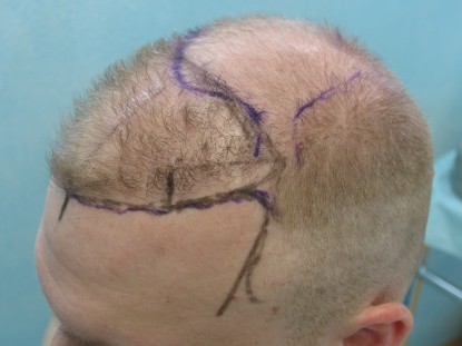 UGraft FUE hair transplant Surgical Planning