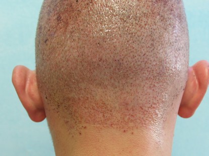 FUE Hair Transplant| Donor Wound Healing | Patient Photo Donor area immediately following transplant.