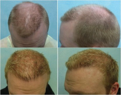 FUE hair transplant on a younger patient.