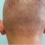 Figure 6a: Tiny wounds of FUE performed by The Umar Procedure, soon after surgery.