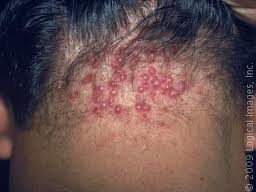 Folliculitis keloidalis | huidinfo.nl | informatiefolder ...