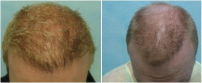 Hair transplant repair of asymmetry.