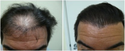 Hair transplant repair of flap surgery.