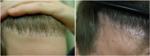Hair transplant repair of "doll's hair" along the hairline.
