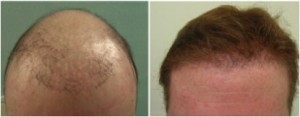 Hair transplant repair of punch scarring.