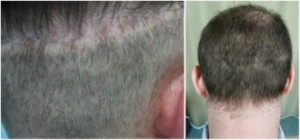 Hair transplant repair of a strip scar.