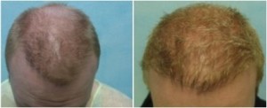 Hair transplant repair of asymmetry.