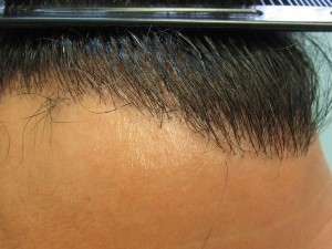 Pluggy hairline before hair transplant repair. After images shown in video below.