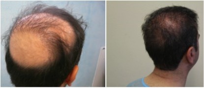 Hair transplant repair of poorly placed/angled hair.